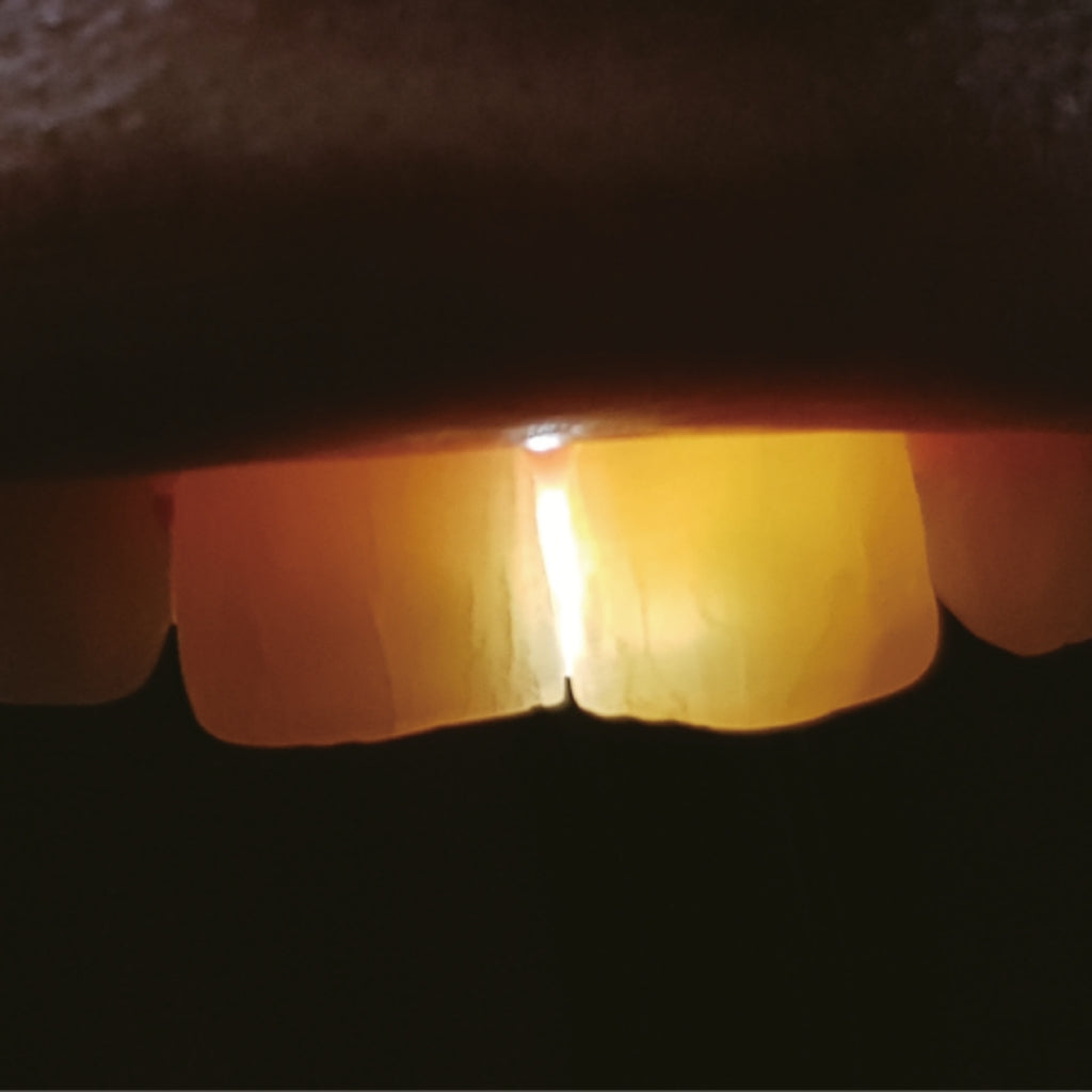 Lámpara de Fotocurado Noblesse E – Max Dental | Ortho Factory México
